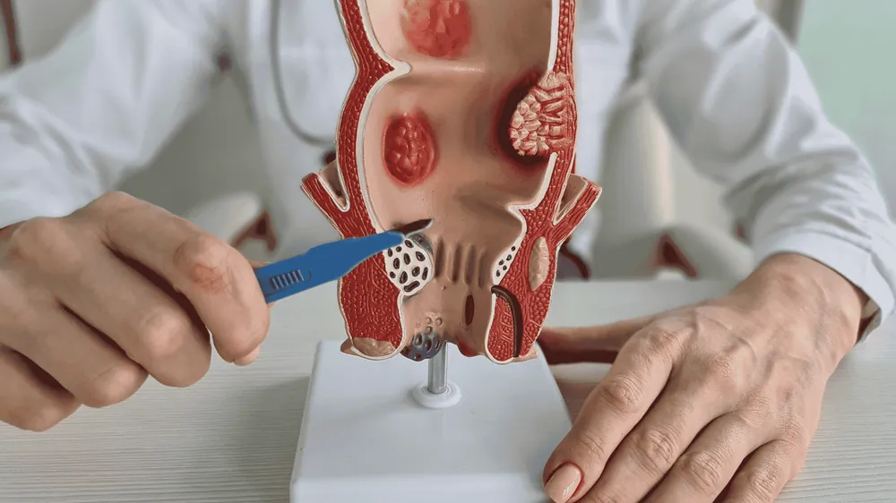 Acalasia: Entenda a Disfagia e o Tratamento