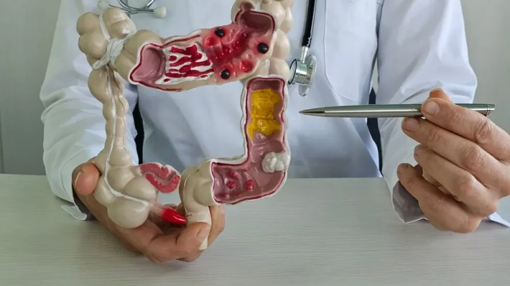Cirurgia para Diverticulite