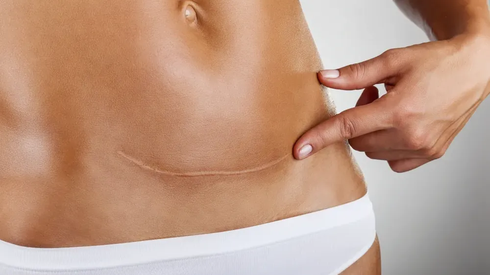 Cuidados com a Cicatrização Após Cirurgias Abdominais
