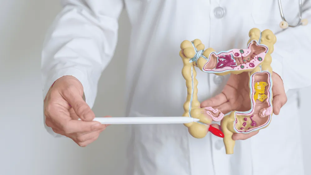 Diverticulose e Diverticulite: Prevenção é a Chave
